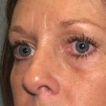 Eye Lid Lift Before & After Patient #682