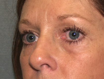 Eye Lid Lift Before & After Patient #682