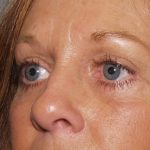 Eye Lid Lift Before & After Patient #682