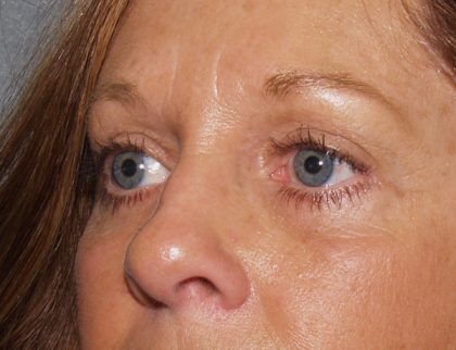 Eye Lid Lift Before & After Patient #682