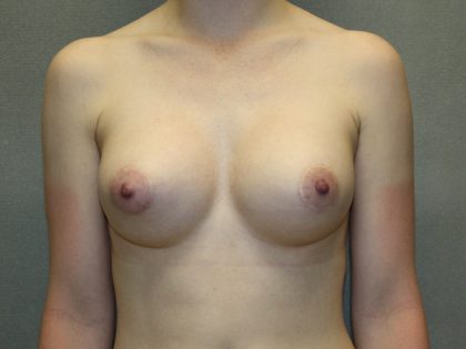 Breast Augmentation Before & After Patient #1509