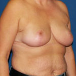 Breast Reduction Before & After Patient #3510