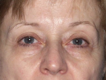 Eye Lid Lift Before & After Patient #695