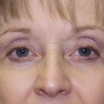 Eye Lid Lift Before & After Patient #695