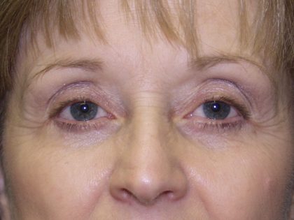 Eye Lid Lift Before & After Patient #695