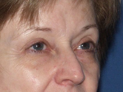 Eye Lid Lift Before & After Patient #695