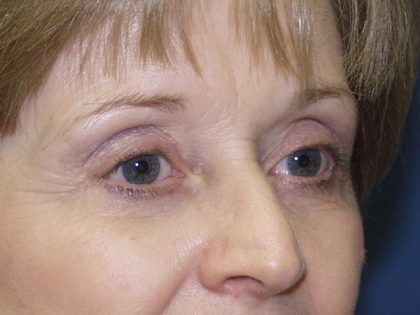 Eye Lid Lift Before & After Patient #695