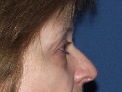 Eye Lid Lift Before & After Patient #695