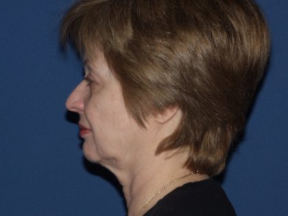 Facelift Before & After Patient #564