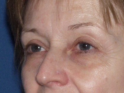 Eye Lid Lift Before & After Patient #695