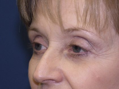 Eye Lid Lift Before & After Patient #695