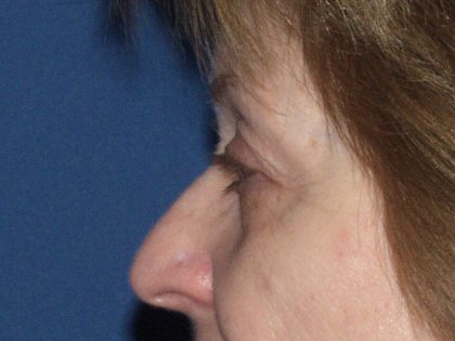 Eye Lid Lift Before & After Patient #695