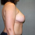 Breast Reduction Before & After Patient #3337