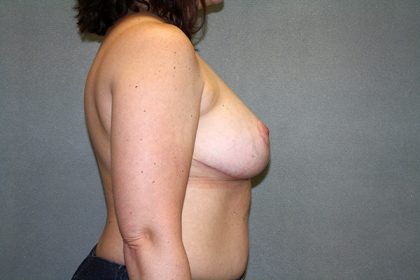 Breast Reduction Before & After Patient #3337