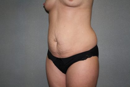 Tummy Tuck Before & After Patient #2309