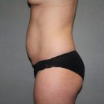 Tummy Tuck Before & After Patient #2309