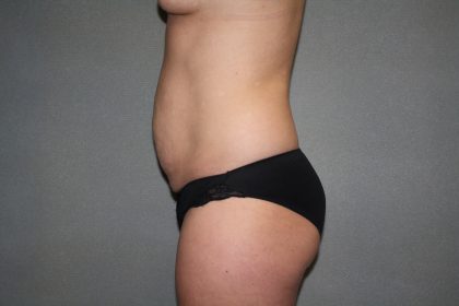 Tummy Tuck Before & After Patient #2309