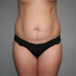 Tummy Tuck Before & After Patient #2309