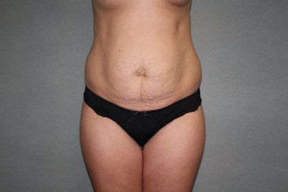 Tummy Tuck Before & After Patient #2309