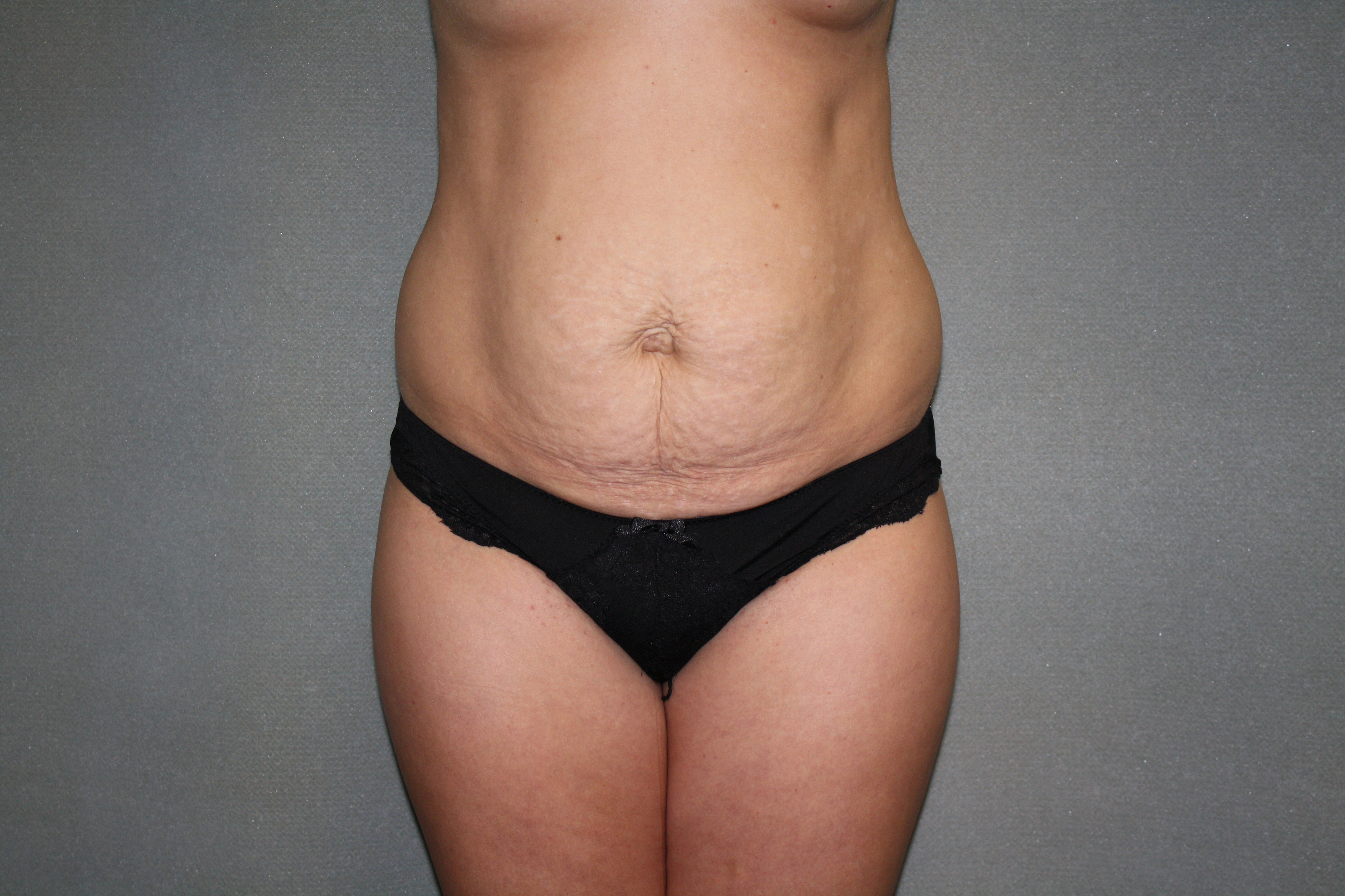 Tummy Tuck Before & After Patient #2309