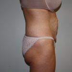 Tummy Tuck Before & After Patient #1934