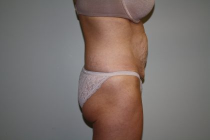 Tummy Tuck Before & After Patient #1934