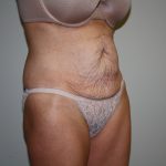 Tummy Tuck Before & After Patient #1934