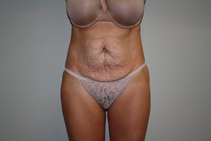 Tummy Tuck Before & After Patient #1934