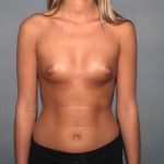 Breast Augmentation Before & After Patient #2969