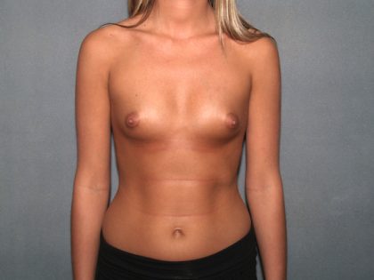 Breast Augmentation Before & After Patient #2969
