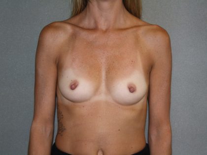 Breast Augmentation Before & After Patient #2517