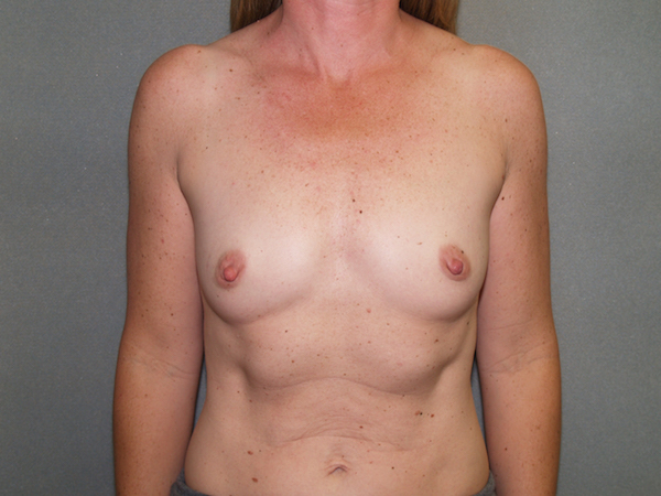 Breast Augmentation Before & After Patient #2559