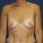 Breast Augmentation Before & After Patient #2545