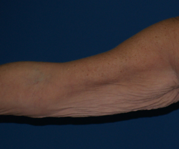 Arm Lift Before & After Patient #846