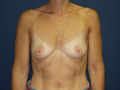 Breast Augmentation Before & After Patient #2545