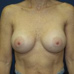 Breast Augmentation Before & After Patient #2545