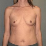 Breast Augmentation Before & After Patient #2640