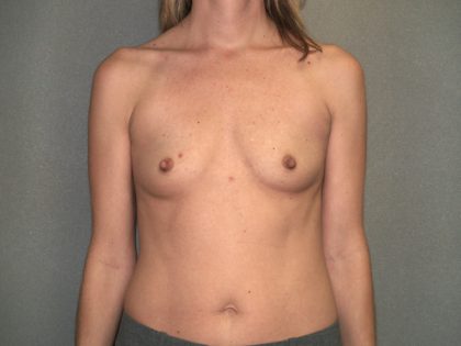 Breast Augmentation Before & After Patient #2640