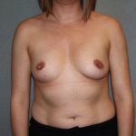 Breast Augmentation Before & After Patient #2682