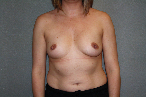 Breast Augmentation Before & After Patient #2682