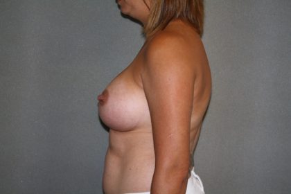 Breast Augmentation Before & After Patient #2682