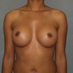 Breast Augmentation Before & After Patient #2668