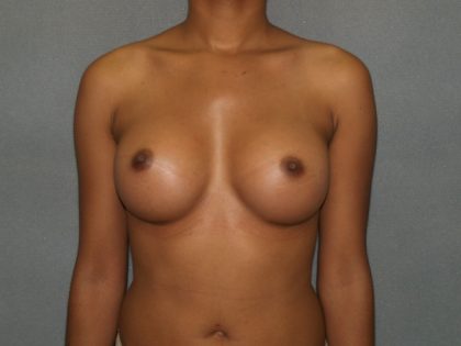 Breast Augmentation Before & After Patient #2668