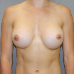 Breast Augmentation Before & After Patient #2745