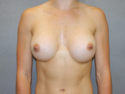 Breast Augmentation Before & After Patient #2745