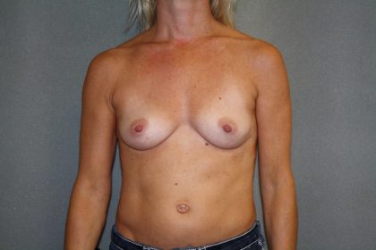Breast Augmentation Before & After Patient #2752