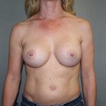 Breast Augmentation Before & After Patient #2752