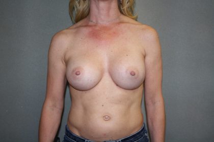 Breast Augmentation Before & After Patient #2752