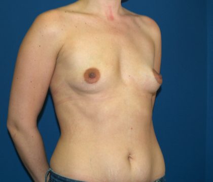 Breast Augmentation Before & After Patient #2759