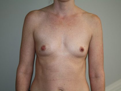 Breast Augmentation Before & After Patient #2850